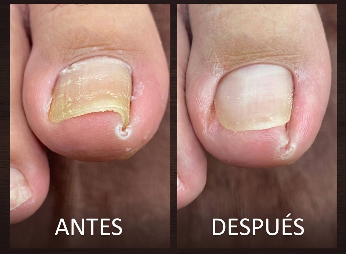 Antes y después de tratamiento de uña encarnada, caso 1