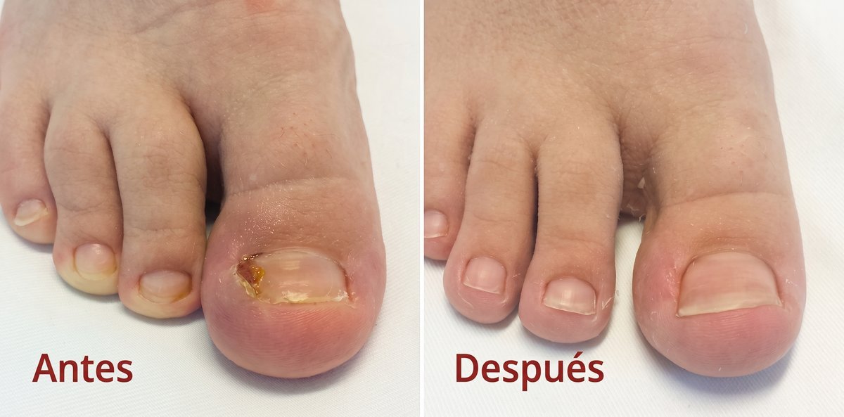 Antes y después de tratamiento de uña encarnada, caso 2
